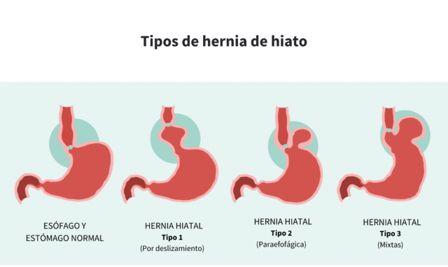 Todo Sobre Las Hernias De Hiato Causas S Ntomas Y Tratamiento