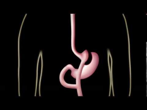 Cirugía Obesidad y Diabetes (Bypass Gástrico o Gastric Bypass)
